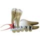 dente-molar-ampliado-com-evolucao-da-carie-em-8-partes-TGD-0311-G--2-
